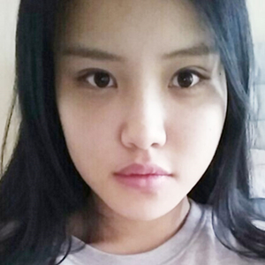 做下頜角整形手術(shù)半年了，給你們看看恢復過程照片吧~