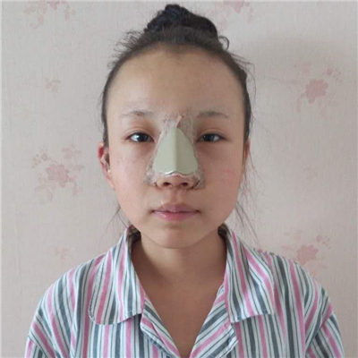 磨下頜角手術(shù)+隆鼻前后對比果圖片分享，高占巍做的哦~