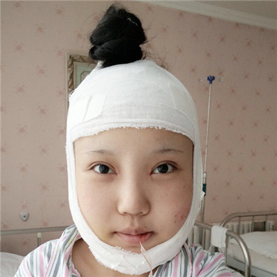 磨下頜角手術(shù)+隆鼻前后對比果圖片分享，高占巍做的哦~