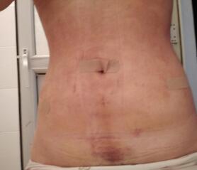 吸脂減肥瘦身果圖