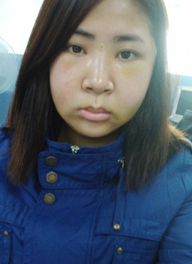 想做小V臉的看過(guò)來(lái)，給大家分享V臉手術(shù)的前后過(guò)程