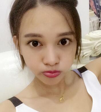 玻尿酸豐太陽7天果圖 愛悅麗格豐太陽穴一個月啦~