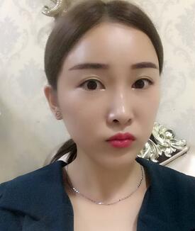 愛悅麗格玻尿酸豐蘋果肌、豐下巴、隆鼻