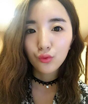 愛悅麗格玻尿酸豐臉頰日記分享