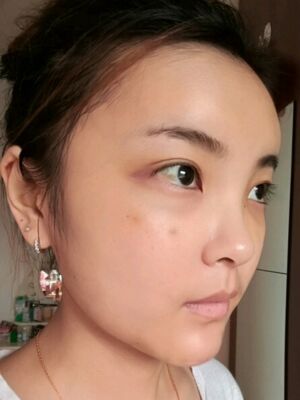 自體脂肪面部填充之后飽滿又自然，廣州曙光劉永波做噠