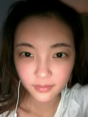 自體脂肪面部填充之后飽滿又自然，廣州曙光劉永波做噠