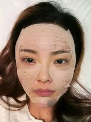 自體脂肪面部填充之后飽滿又自然，廣州曙光劉永波做噠