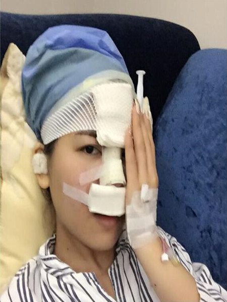 終于做里隆鼻整形手術(shù) 快來圍觀我時候果吧