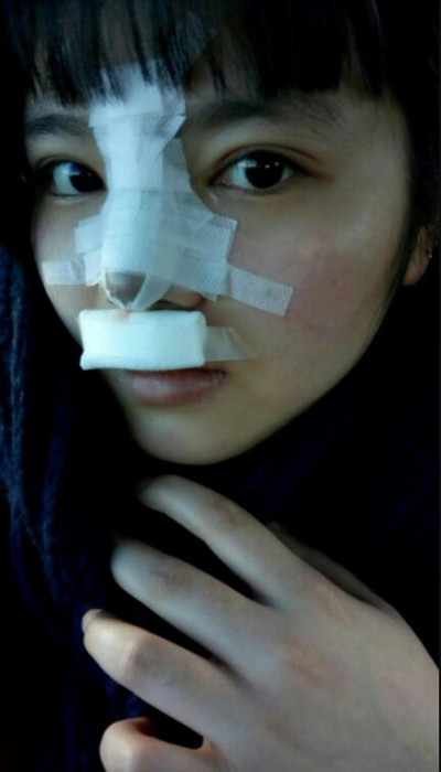 假體隆鼻加耳軟骨墊鼻尖讓我變成巴拉拉小魔仙