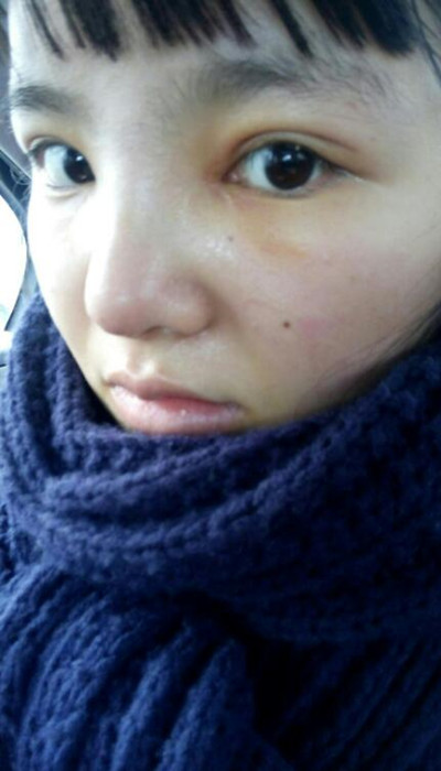 假體隆鼻加耳軟骨墊鼻尖讓我變成巴拉拉小魔仙