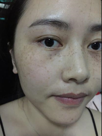 皮膚美容激光祛斑讓我基本告別小雀斑