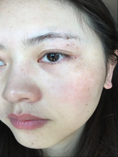 皮膚美容激光祛斑讓我基本告別小雀斑