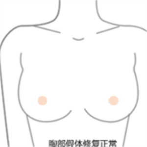 老媽隆胸失敗假體取出，還是自然點好~