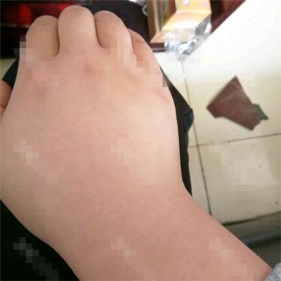 做了副乳吸脂手術(shù)半年了，分享前后對(duì)比果圖片~