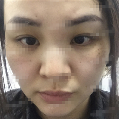 面部奧美定取出手術(shù)前后對比果圖片分享，銅雀臺做的呢~