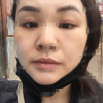 面部奧美定取出手術(shù)前后對比果圖片分享，銅雀臺做的呢~