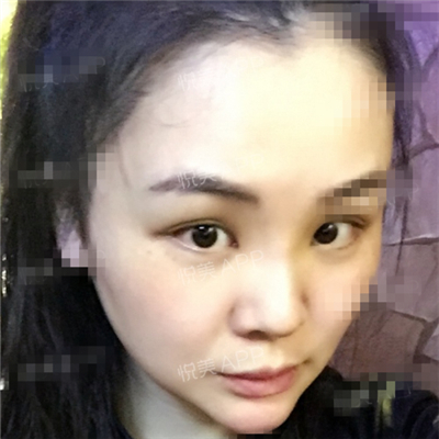 面部奧美定取出手術(shù)前后對比果圖片分享，銅雀臺做的呢~