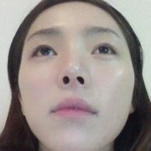 玻尿酸注射豐額頭前后對比果圖片分享，銅雀臺做的哦~