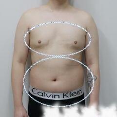 吸脂減肥手術(shù)瘦身，也算一個(gè)正能量胖子逆襲的故事吧