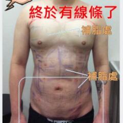 吸脂減肥手術(shù)瘦身，也算一個(gè)正能量胖子逆襲的故事吧