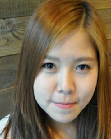 玻尿酸去法令紋之前的照片