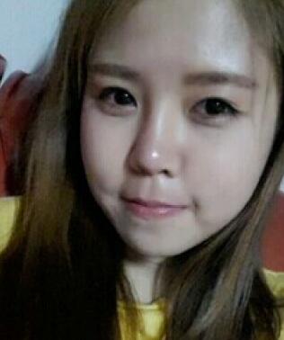 玻尿酸后，法令紋明X減輕了很多