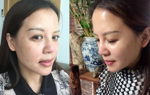 蛋白埋埋蛋白線.提升手術(shù)前后對比照片