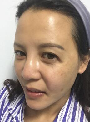 蛋白埋埋蛋白線.提升手術(shù)前照片