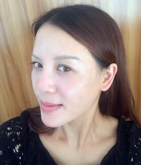 蛋白埋埋蛋白線.提升手術(shù)前后對比照片，術(shù)后第(一)天