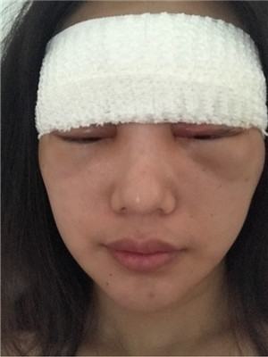 自體脂肪隆眉弓后，更有精神了