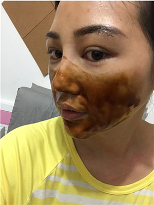 自體脂肪隆眉弓后，更有精神了