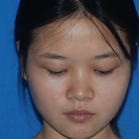 玻尿酸隆鼻改變了大鼻翼給大家分享下我的恢復過程