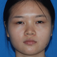 玻尿酸隆鼻改變了大鼻翼給大家分享下我的恢復過程