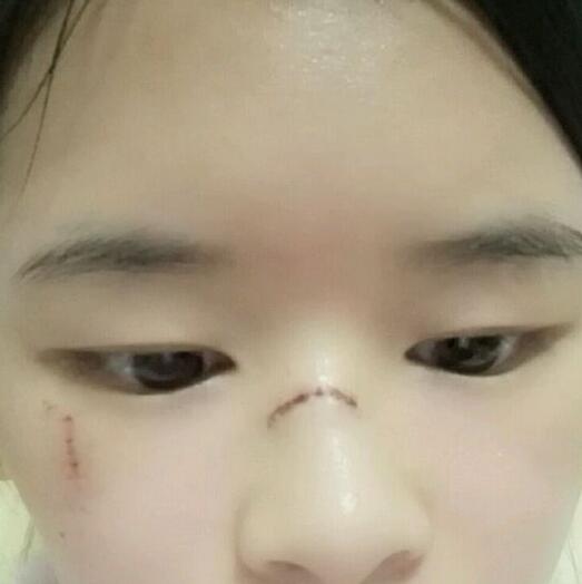 分享手術(shù)切除祛疤恢復(fù)過程希望對大家有幫助