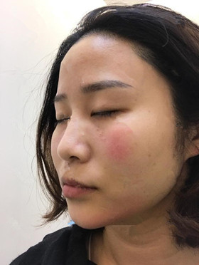 記錄了玻尿酸填充淚溝手術(shù)前后過程，還有前后對比圖哦