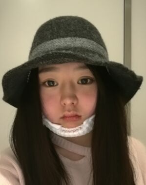 廣州曙光劉永波做的雙下巴吸脂后臉型好看多了