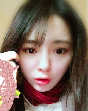 廣州曙光劉永波做的雙下巴吸脂后臉型好看多了