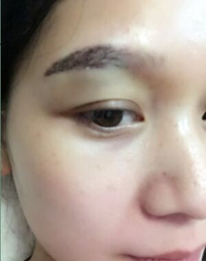很淡的眉毛做完眉毛種植之后濃密多了