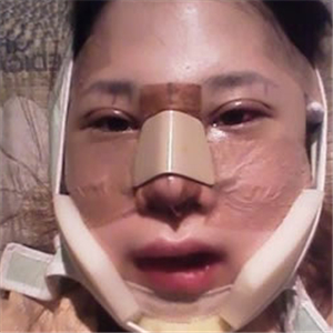 自體脂肪移植隆鼻手術前后對比果圖片，恢復過程分享給大家~