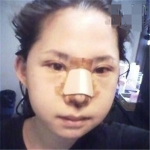 自體脂肪移植隆鼻手術前后對比果圖片，恢復過程分享給大家~