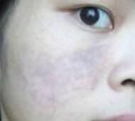 激光去胎記——長達(dá)一年的激光太田痣青色胎記緩解過程分享
