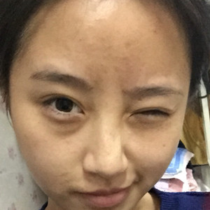 做了玻尿酸隆眉弓，感覺棒棒噠