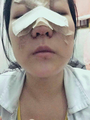 做了隆鼻整形手術(shù)，給大家分享一下手術(shù)過程，還有對比照片哦