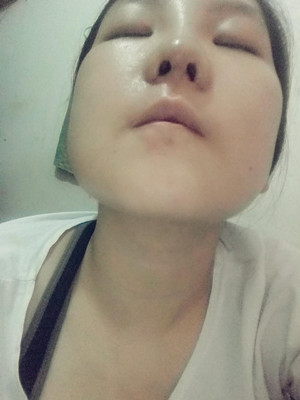 做了隆鼻整形手術(shù)，給大家分享一下手術(shù)過程，還有對比照片哦