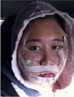 分享下頜角整形手術(shù)前后過程，還有對比照哦