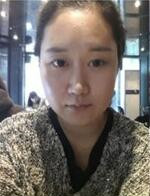 分享下頜角整形手術(shù)前后過程，還有對比照哦