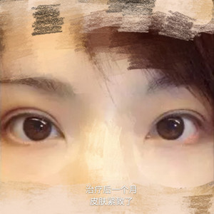 做了眼部電波l皮，一下子年輕了不少啊