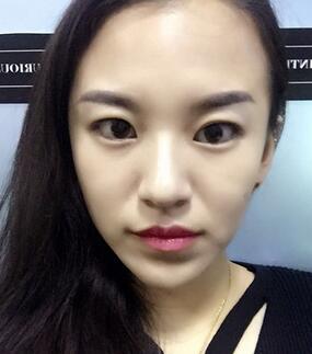 梨花雨注射注射瘦臉去眉間紋日記