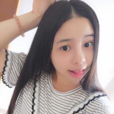 隆鼻整形真實(shí)恢復(fù)期圖片 隆鼻整形一個(gè)月了