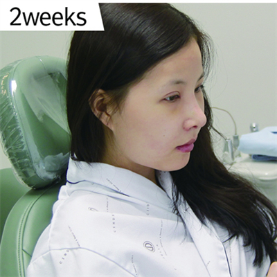 曹仁昌做的雙眼皮，分享下恢復(fù)前后對比果照片哦~